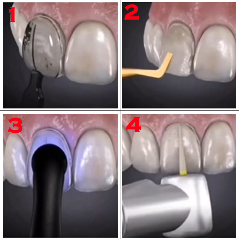 Dental Mould For Composite Res - Teeth Whitening Moulds 리뷰 및 가격