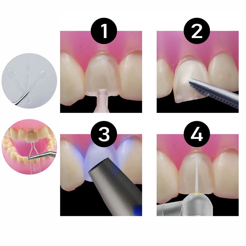 32pcs/Set Composite Resin Mold - Teeth Whitening Moulds 리뷰 및 가격