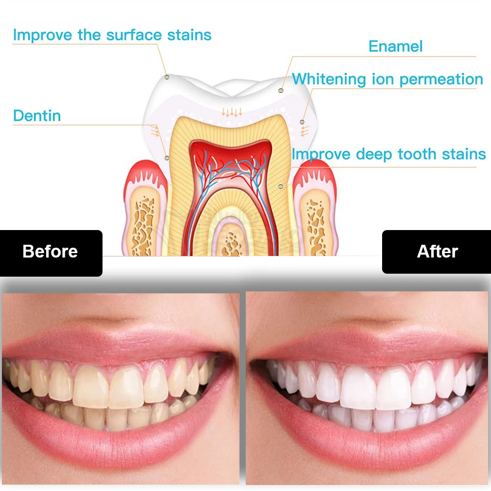 Dental Teeth Whitening Kit Min - Teeth Whitening Clinic 리뷰 및 가격