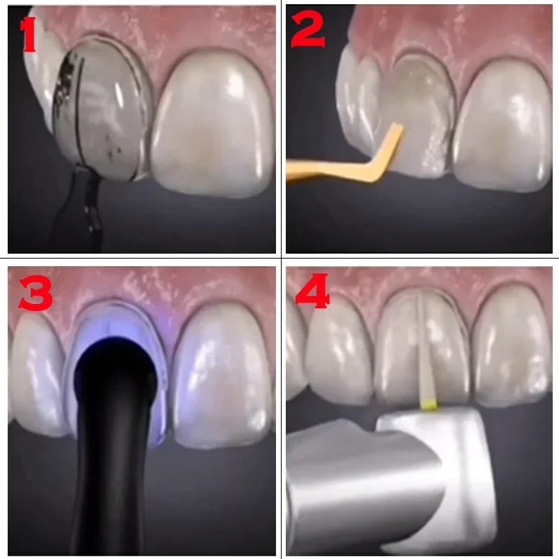 Dental Mould For Composite Res - Teeth Whitening Moulds 리뷰 및 가격