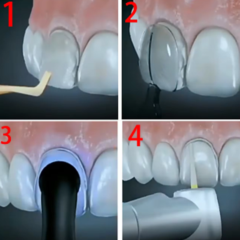 32Pcs/Box Dental Veneer Mould  - Teeth Whitening Moulds 리뷰 및 가격